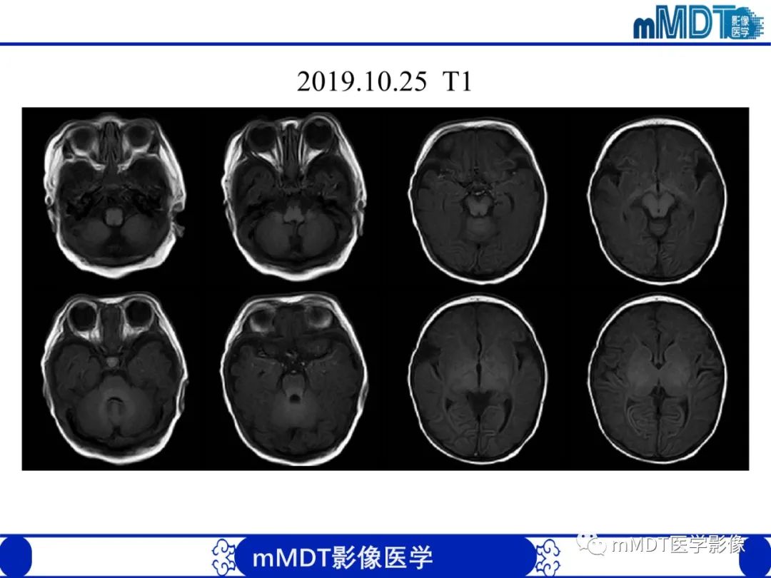 【PPT】新生儿HIE影像学表现-32