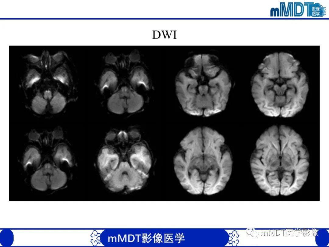 【PPT】新生儿HIE影像学表现-36
