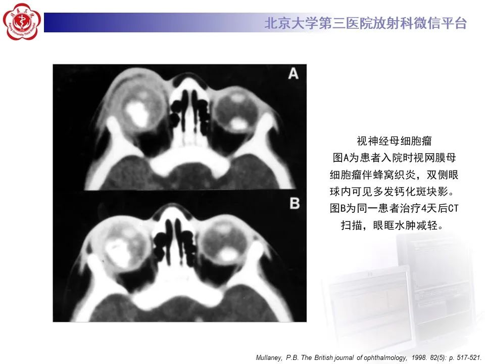 【PPT】脉络膜黑色素瘤的影像-26