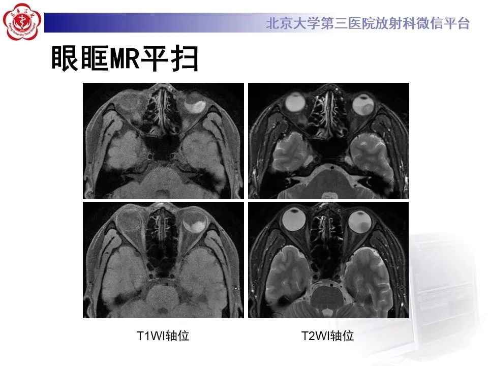 【PPT】脉络膜黑色素瘤的影像-3