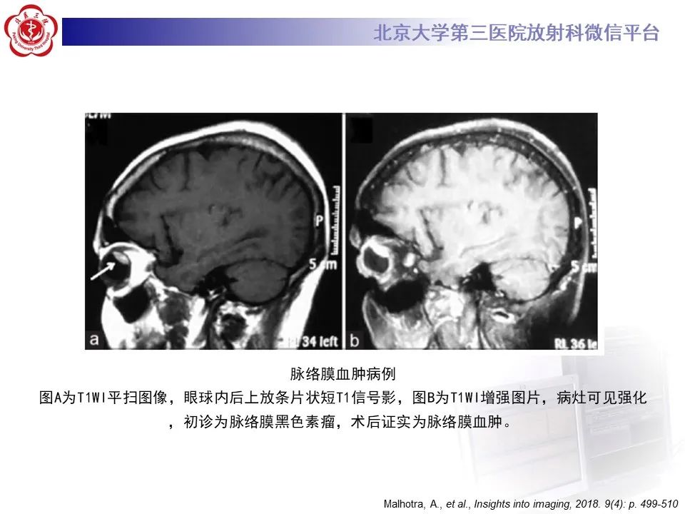 【PPT】脉络膜黑色素瘤的影像-37