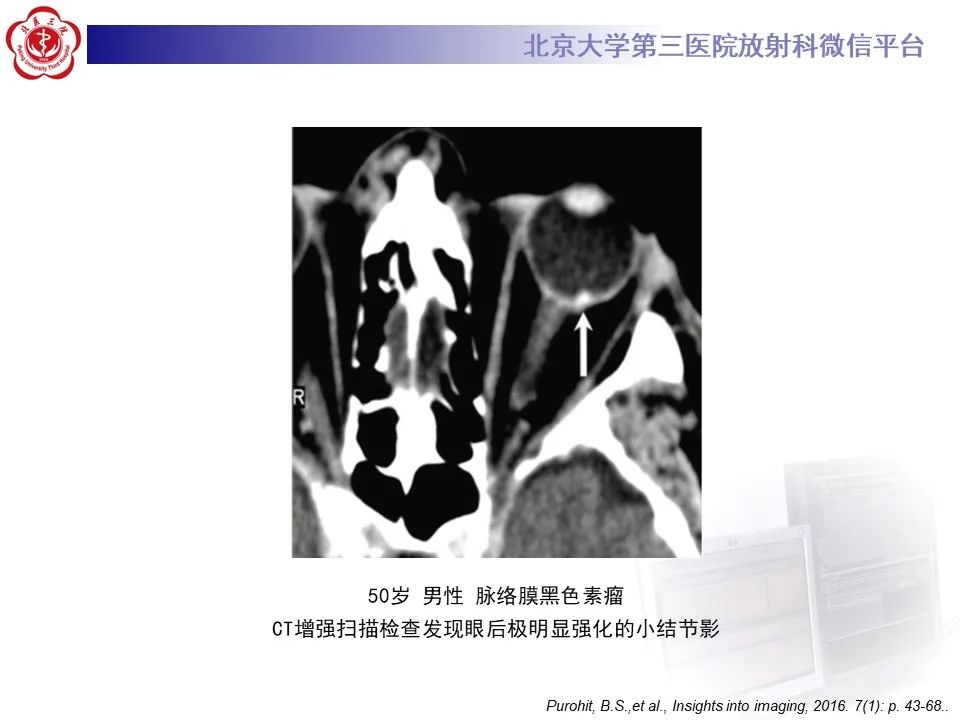 【PPT】脉络膜黑色素瘤的影像-16