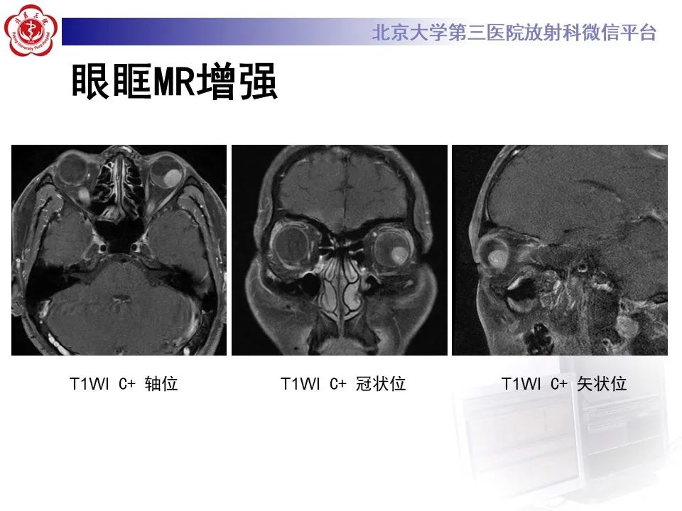 【PPT】脉络膜黑色素瘤的影像-5
