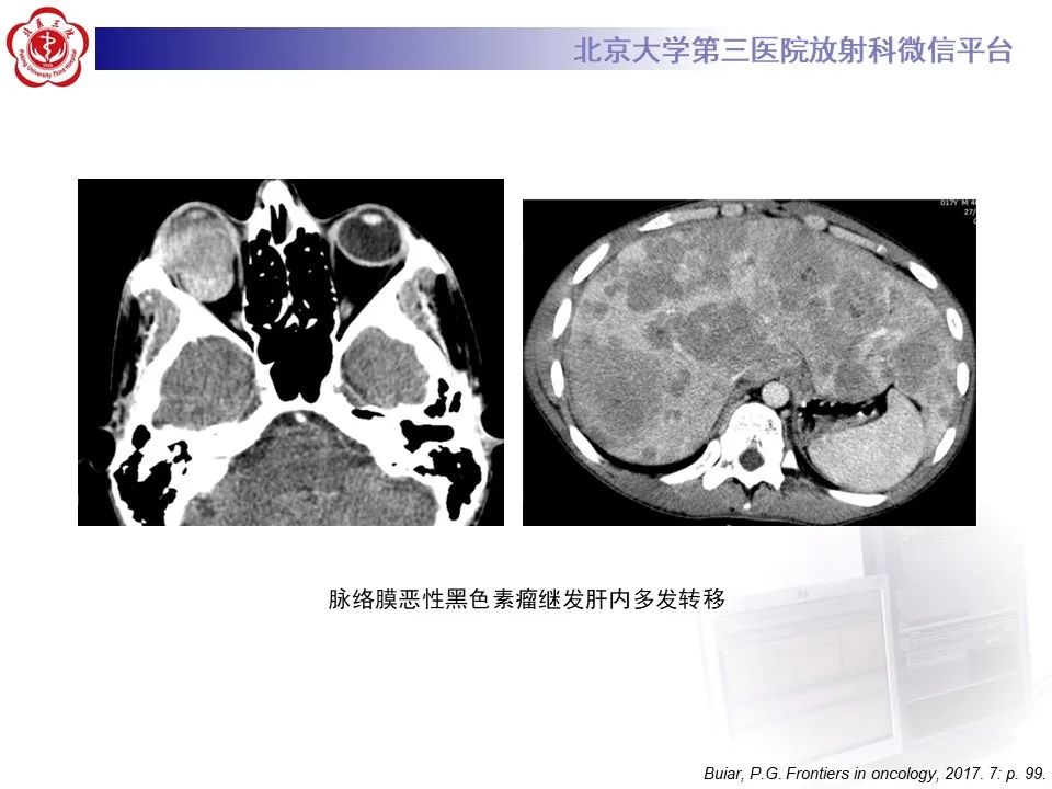 【PPT】脉络膜黑色素瘤的影像-17