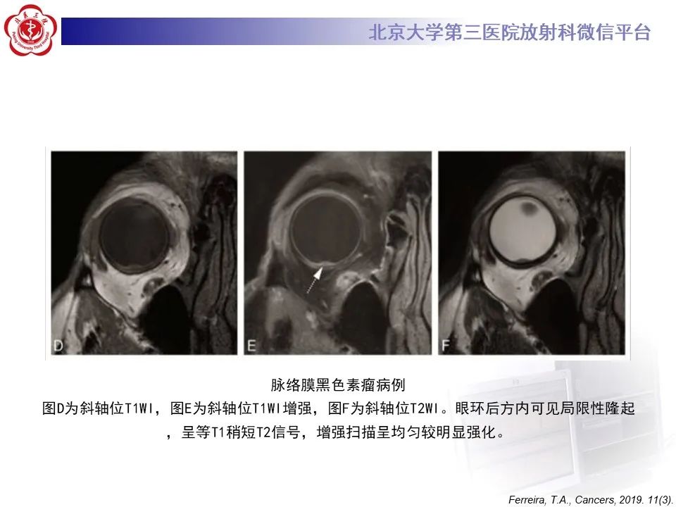 【PPT】脉络膜黑色素瘤的影像-19