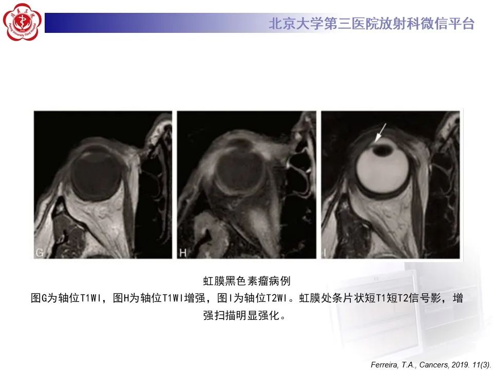 【PPT】脉络膜黑色素瘤的影像-22