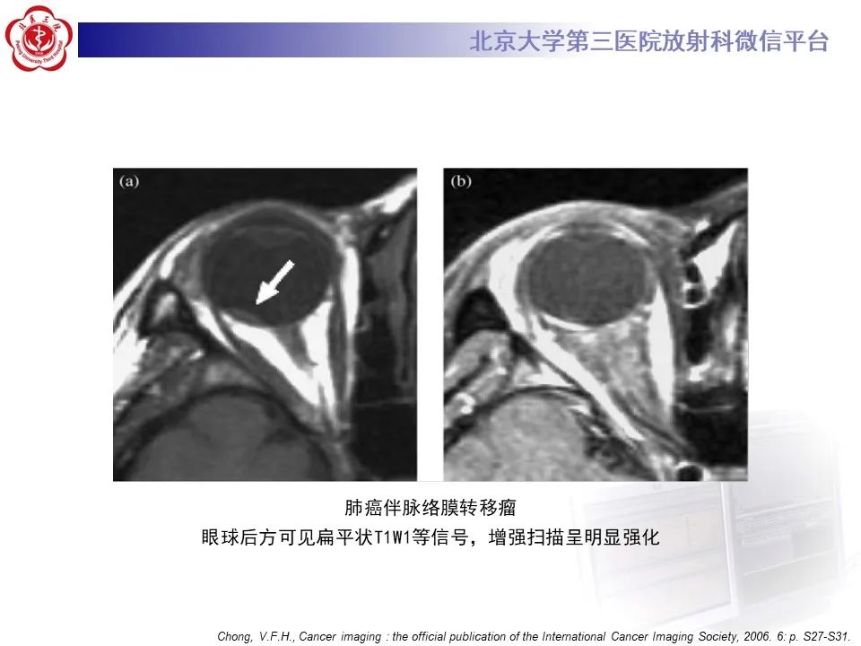 【PPT】脉络膜黑色素瘤的影像-33