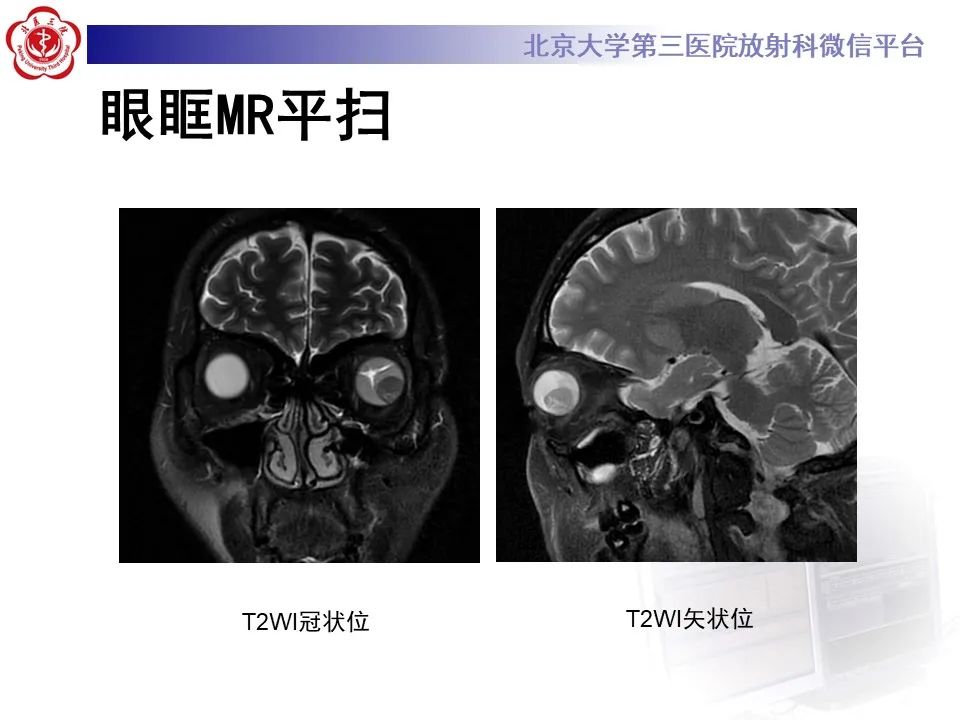 【PPT】脉络膜黑色素瘤的影像-4