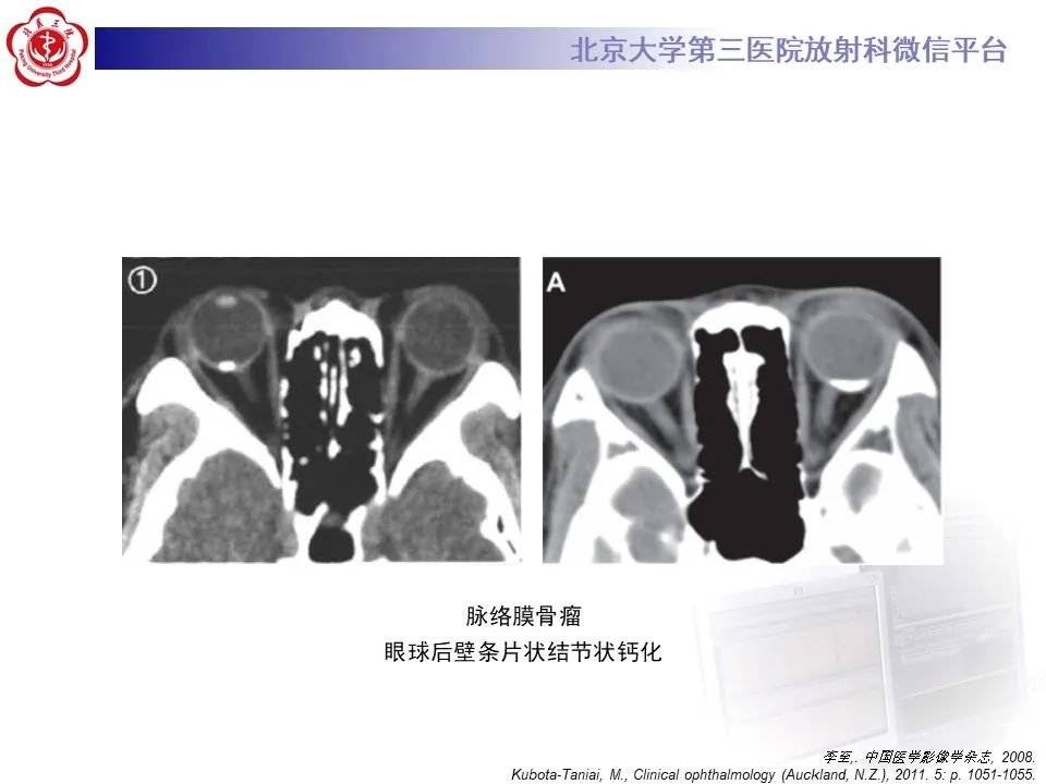 【PPT】脉络膜黑色素瘤的影像-35