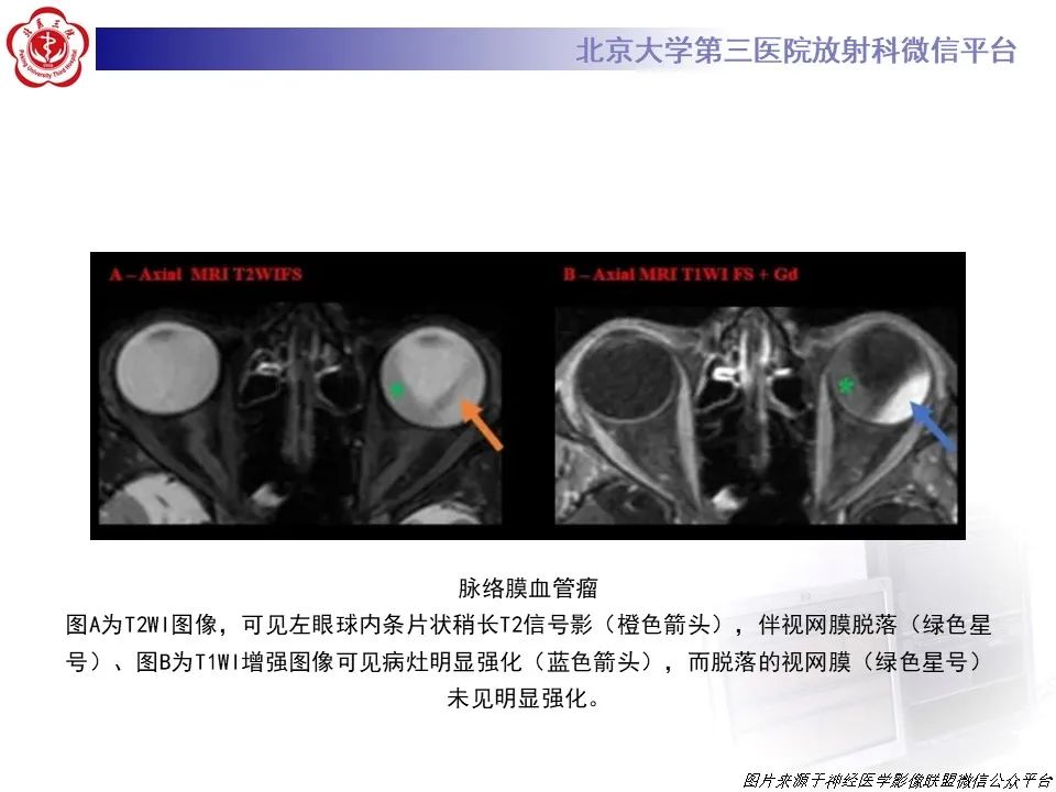 【PPT】脉络膜黑色素瘤的影像-31