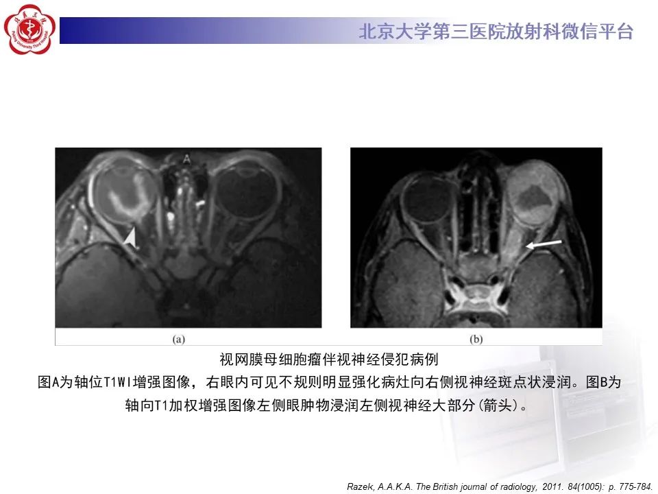 【PPT】脉络膜黑色素瘤的影像-28
