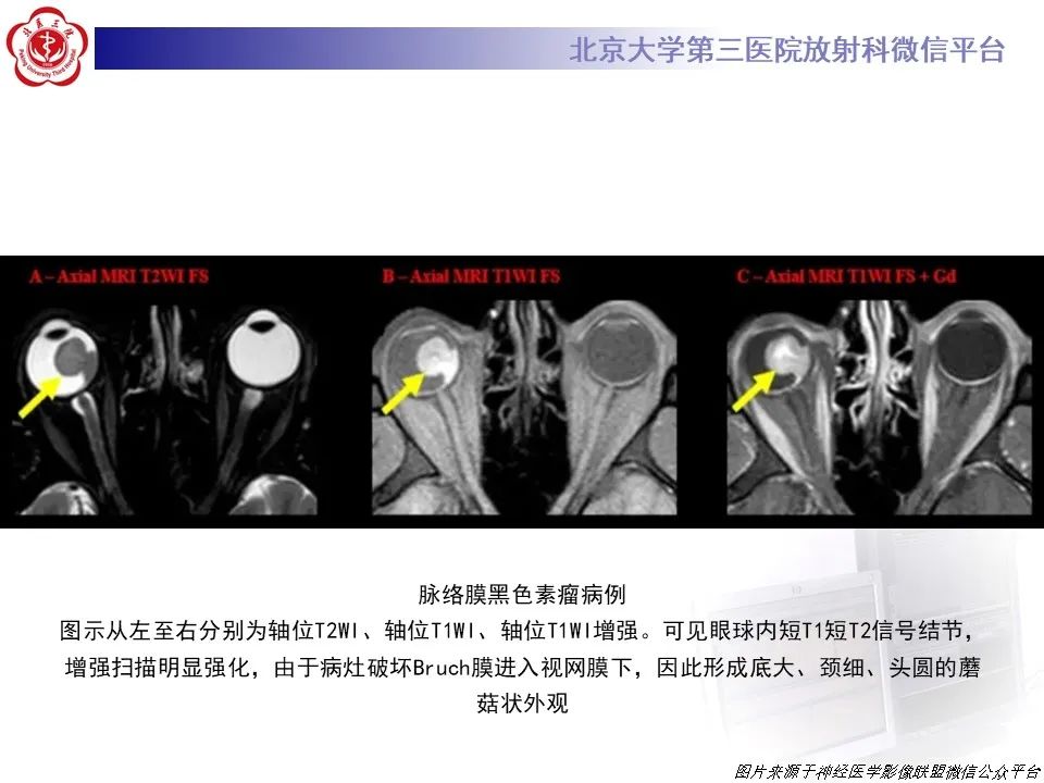 【PPT】脉络膜黑色素瘤的影像-21