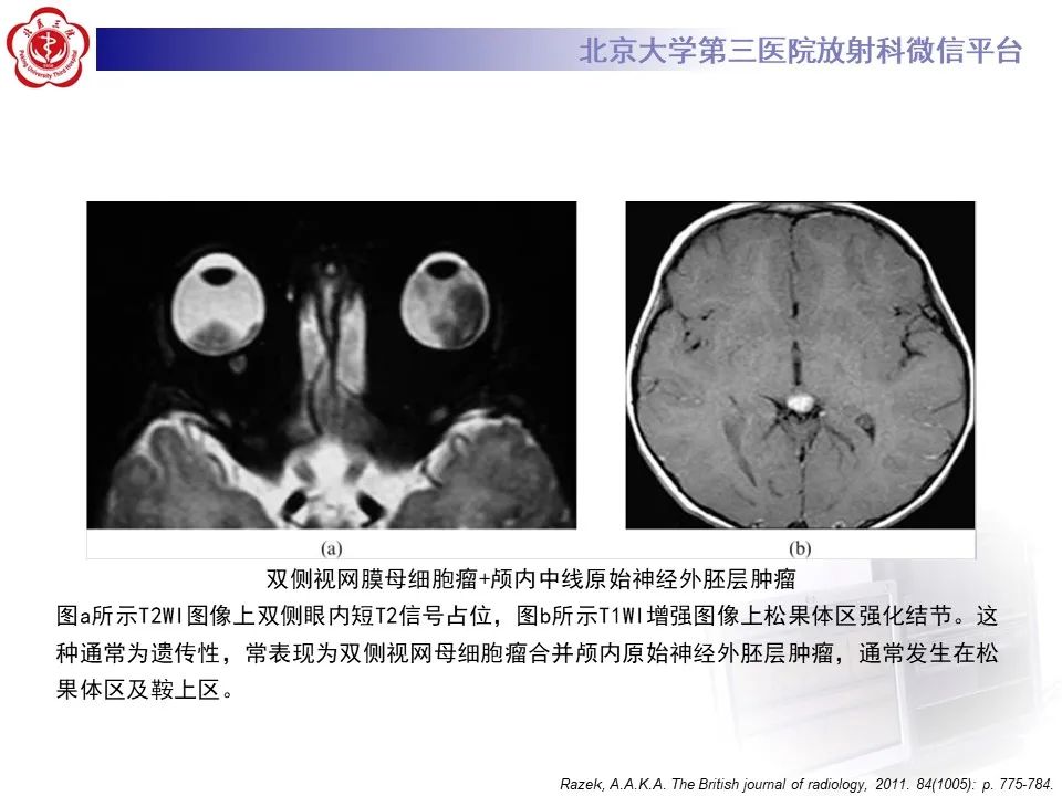 【PPT】脉络膜黑色素瘤的影像-29