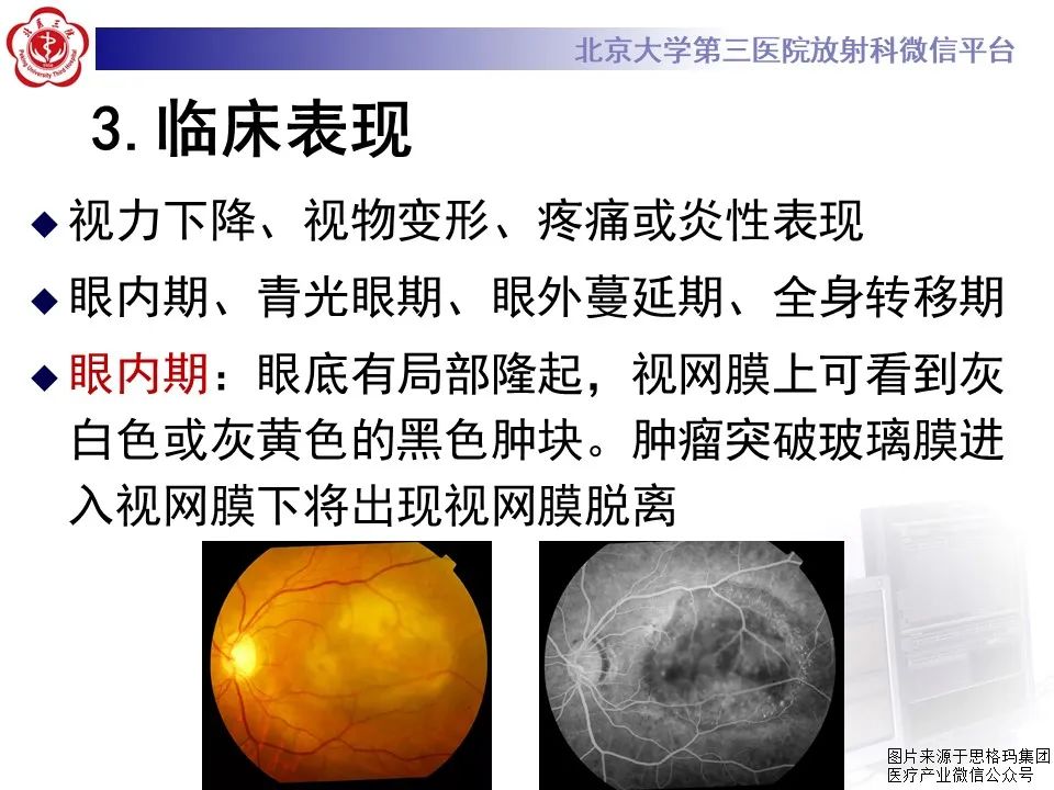 【PPT】脉络膜黑色素瘤的影像-12