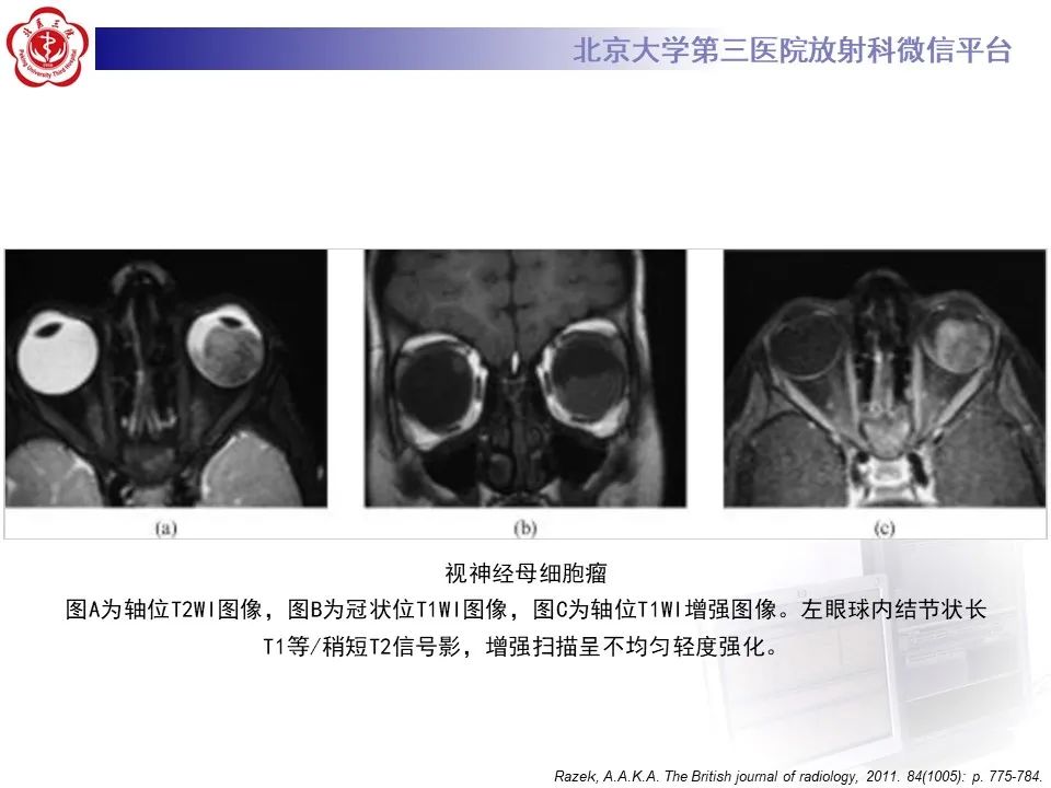 【PPT】脉络膜黑色素瘤的影像-27