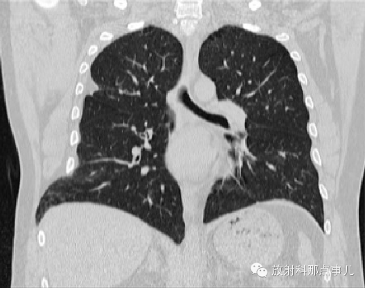 【病例学习】较少见的肺疝一例