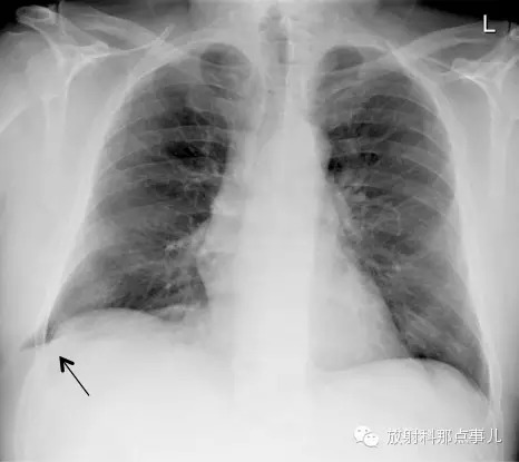 【病例学习】较少见的肺疝一例