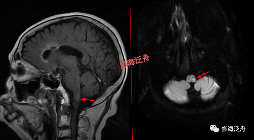 颅脑MR中易漏诊点全面总结-4