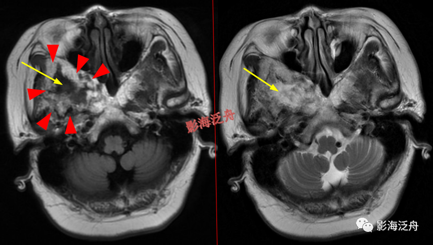 颅脑MR中易漏诊点全面总结-12