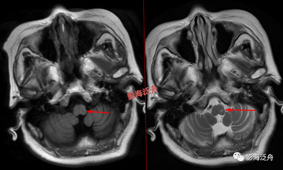 颅脑MR中易漏诊点全面总结-3