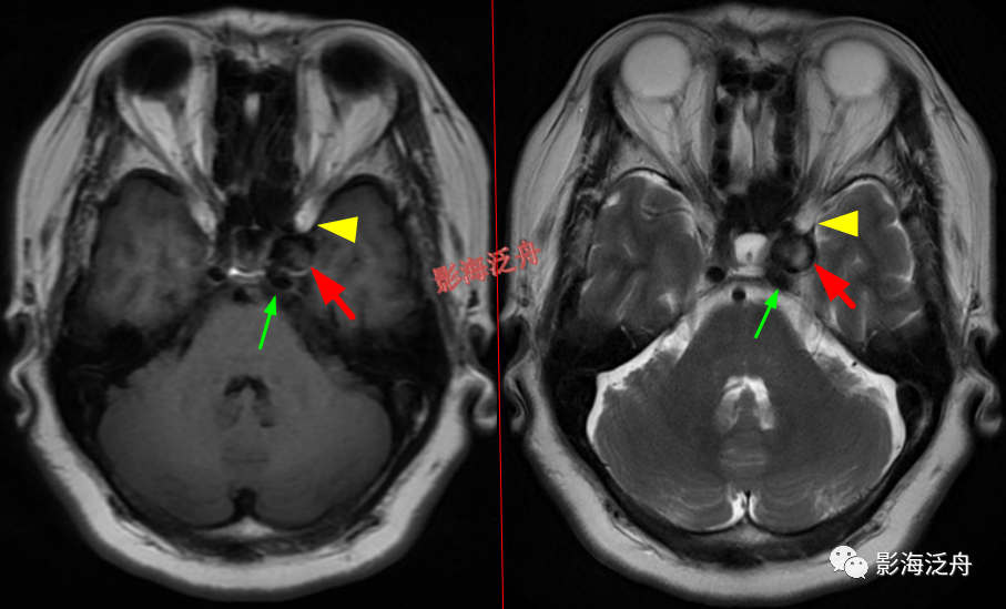 颅脑MR中易漏诊点全面总结-20