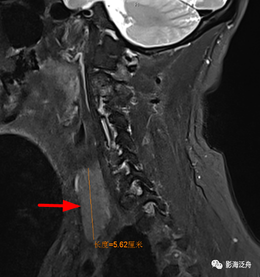 颅脑MR中易漏诊点全面总结-30