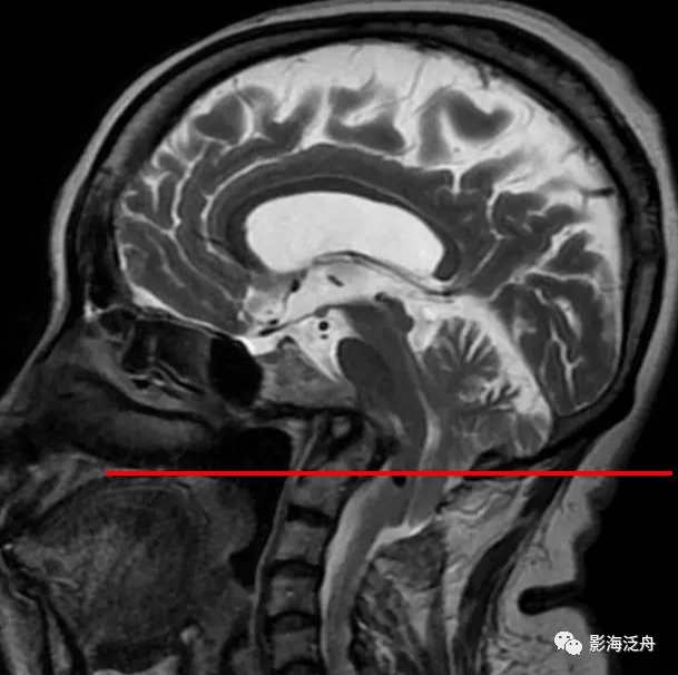颅脑MR中易漏诊点全面总结-16