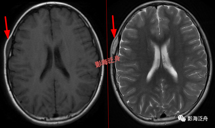 颅脑MR中易漏诊点全面总结-18