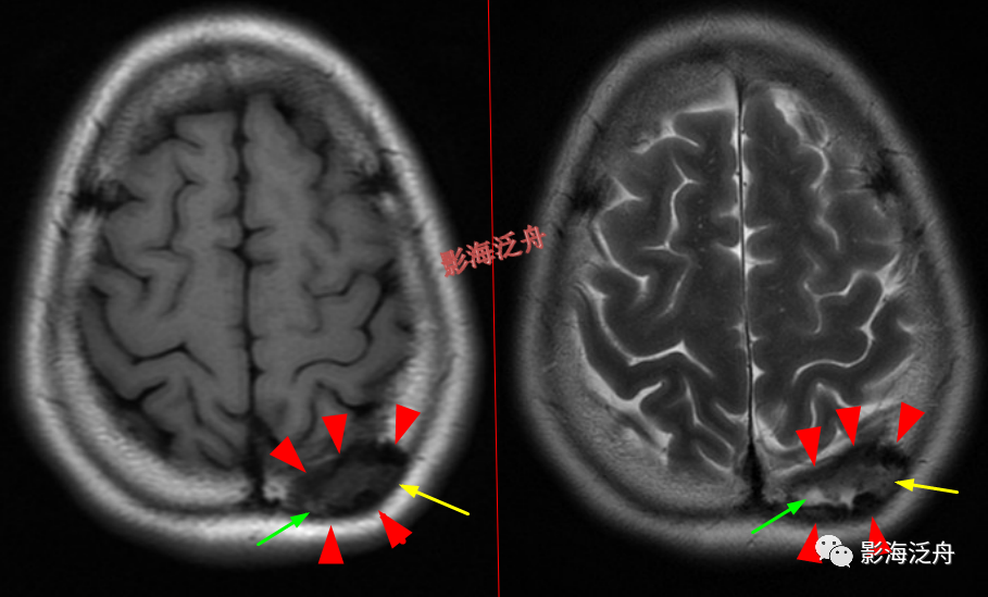 颅脑MR中易漏诊点全面总结-14