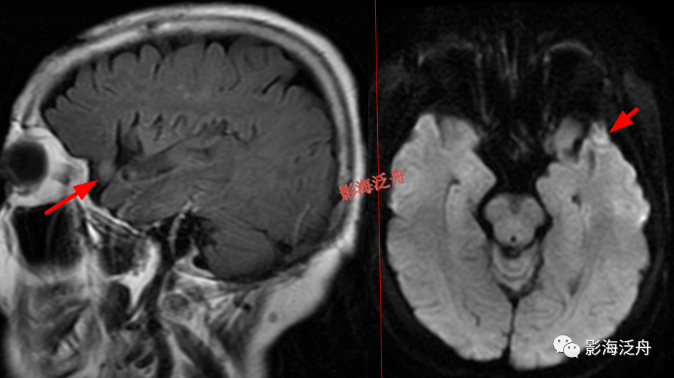 颅脑MR中易漏诊点全面总结-2