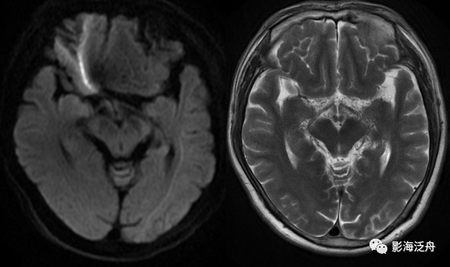 颅脑MR中易漏诊点全面总结-9