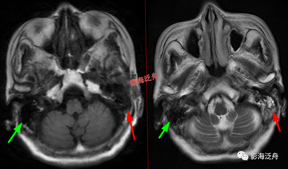 颅脑MR中易漏诊点全面总结-26