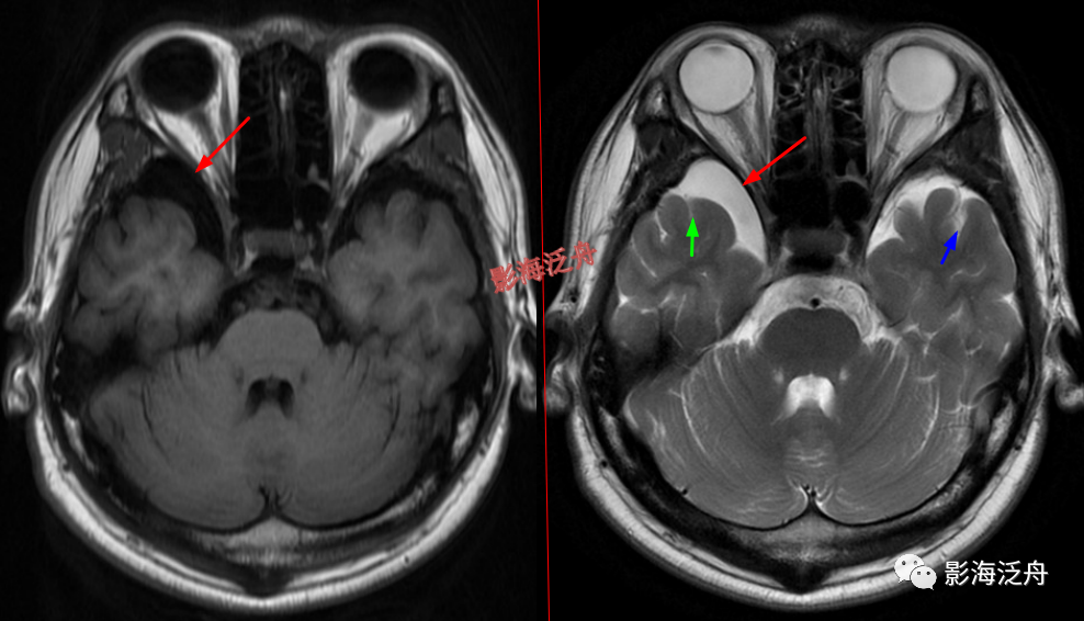 颅脑MR中易漏诊点全面总结-5