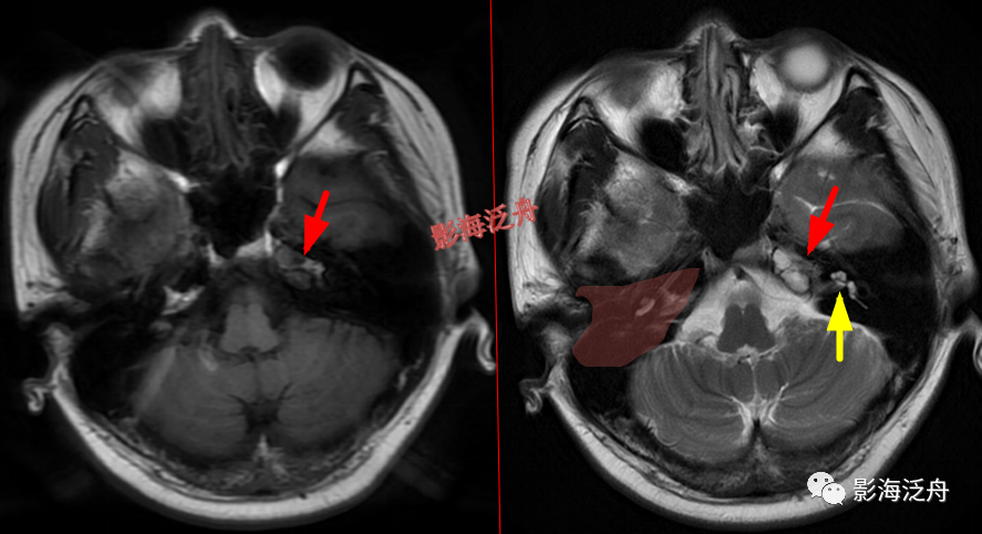 颅脑MR中易漏诊点全面总结-11