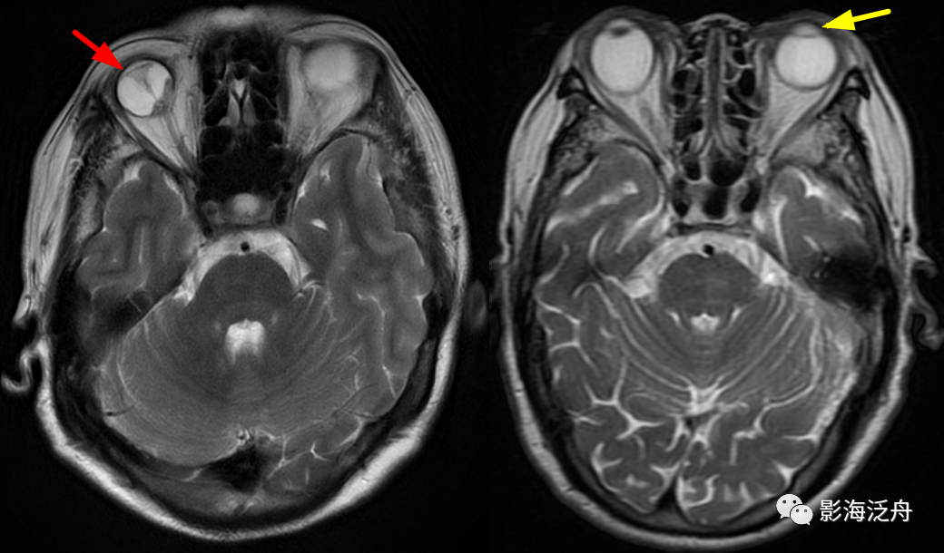 颅脑MR中易漏诊点全面总结-25