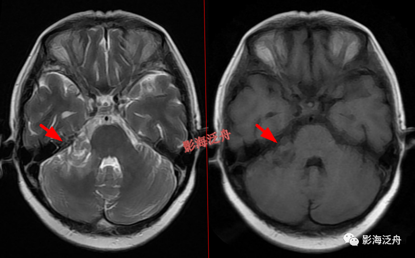 颅脑MR中易漏诊点全面总结-23