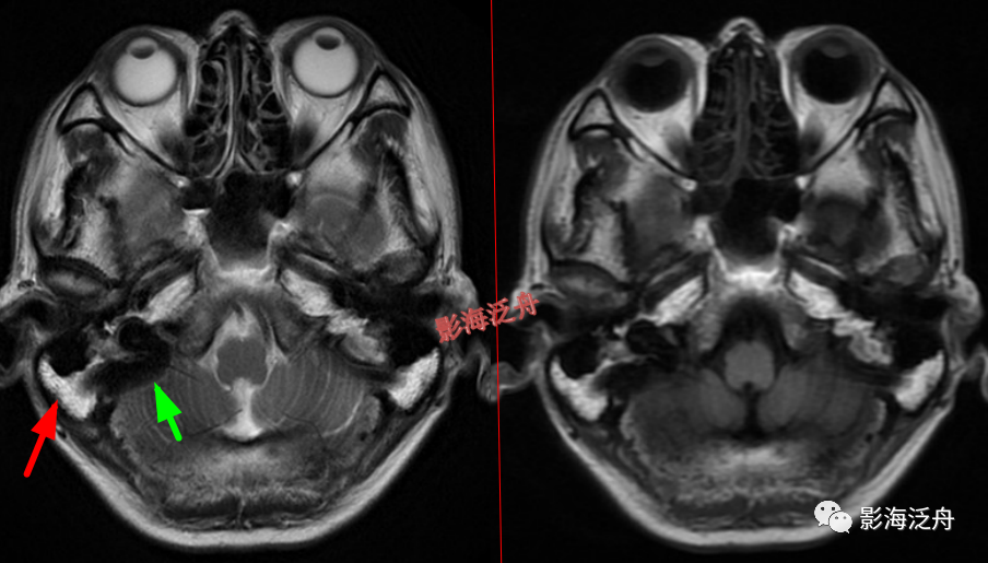 颅脑MR中易漏诊点全面总结-27
