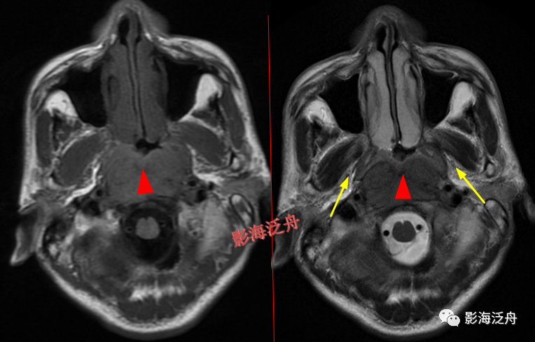 颅脑MR中易漏诊点全面总结-28