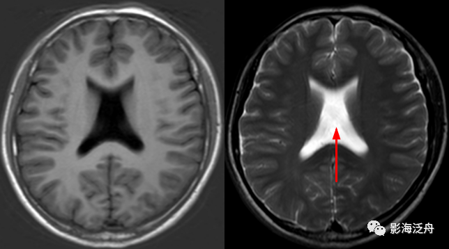 颅脑MR中易漏诊点全面总结-8