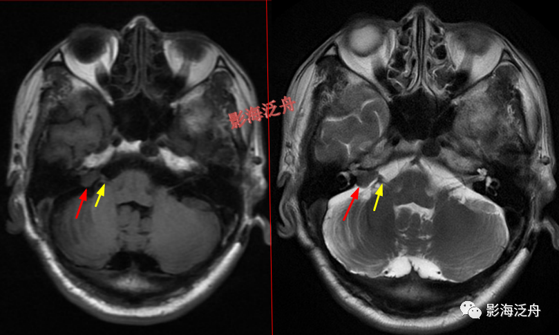 颅脑MR中易漏诊点全面总结-22