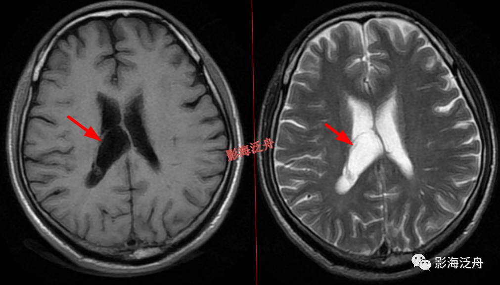 颅脑MR中易漏诊点全面总结-6