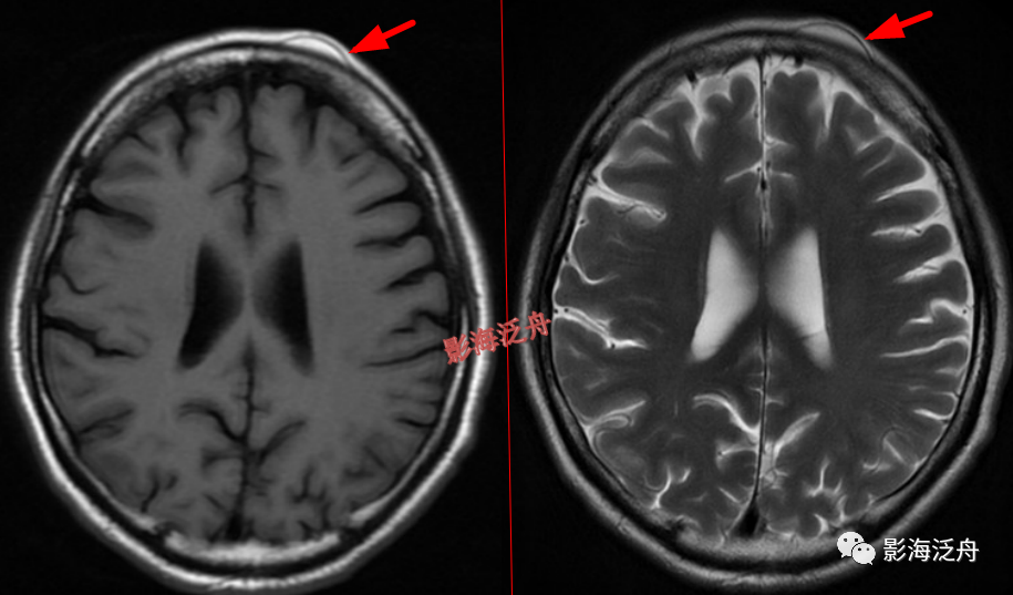 颅脑MR中易漏诊点全面总结-17