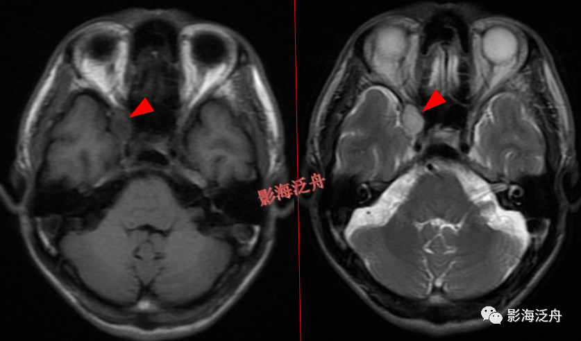 颅脑MR中易漏诊点全面总结-21
