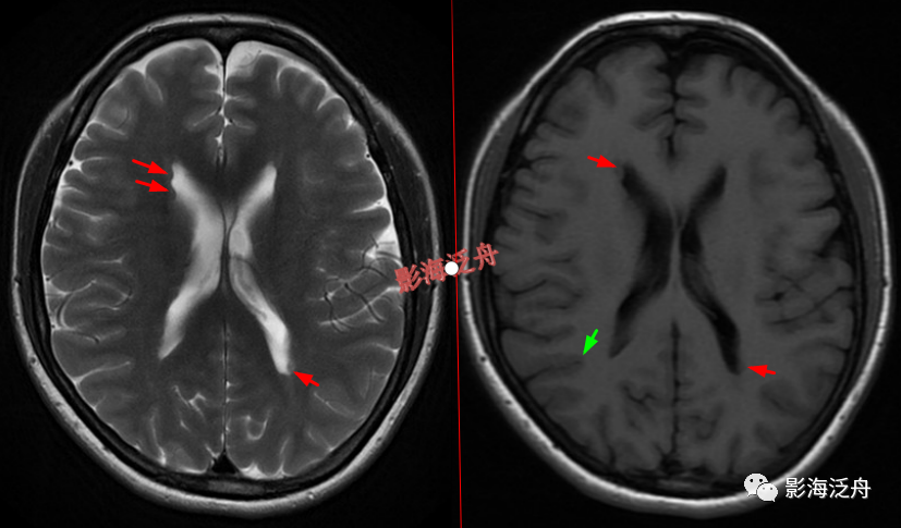 颅脑MR中易漏诊点全面总结-7