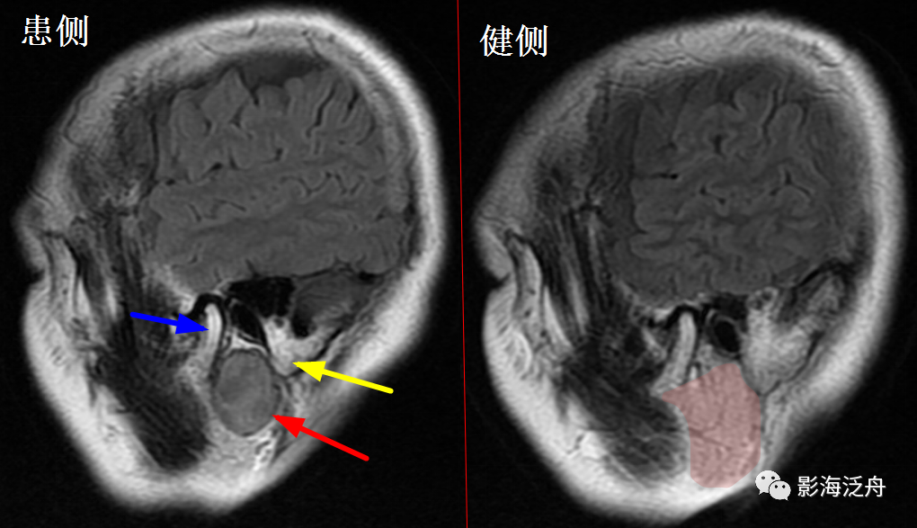 颅脑MR中易漏诊点全面总结-29
