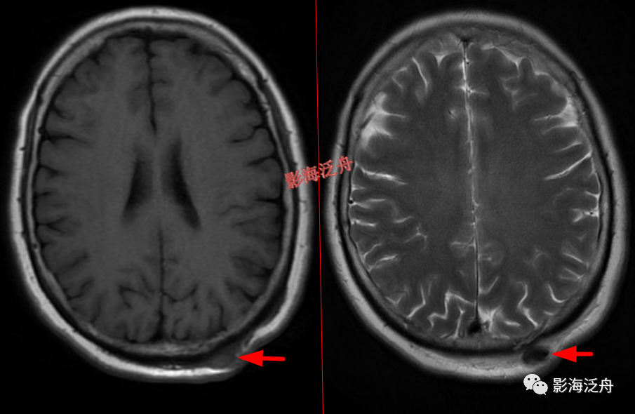 颅脑MR中易漏诊点全面总结-19