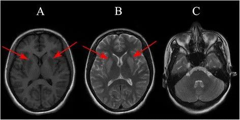 渗透性髓鞘溶解及其影像解析