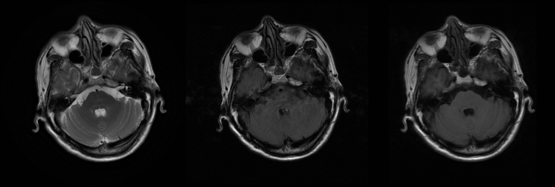 渗透性髓鞘溶解及其影像解析