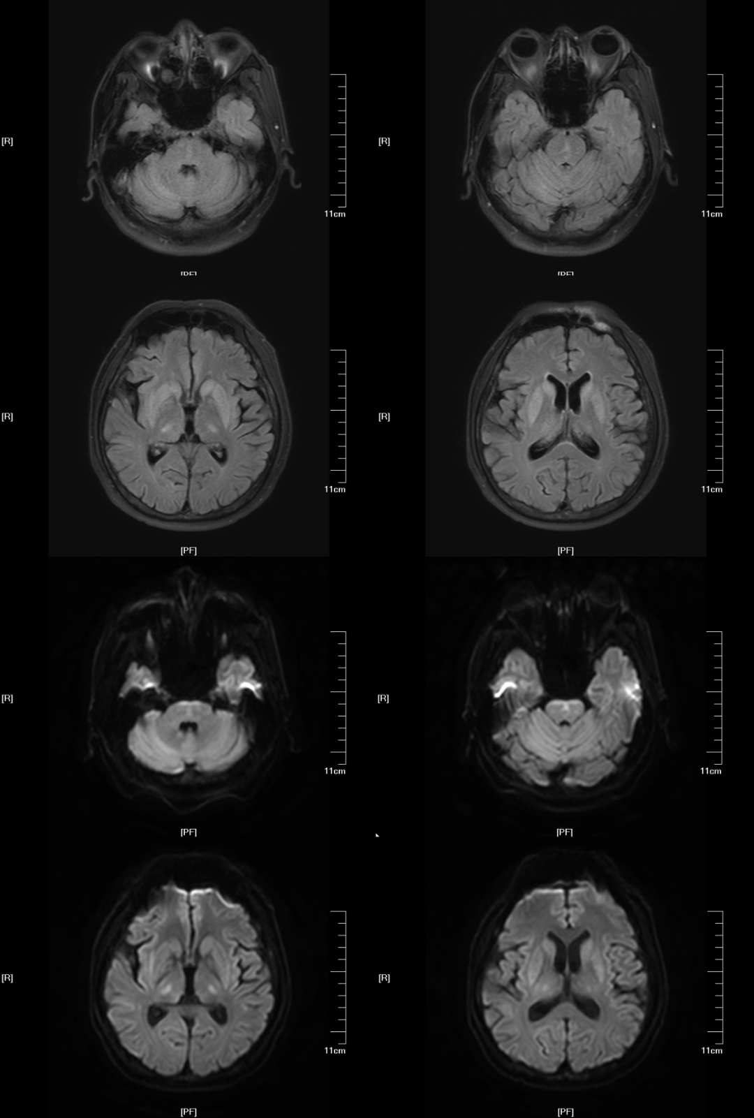 渗透性髓鞘溶解及其影像解析