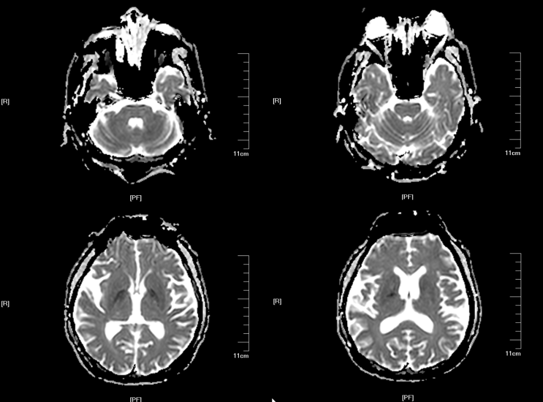 渗透性髓鞘溶解及其影像解析
